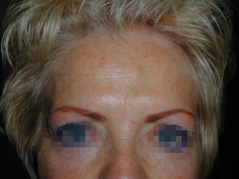 Photo après injection de botox dans le visage par le chirurgien