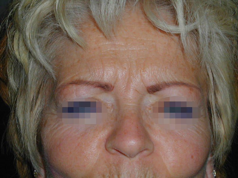 Photo avant injection de botox dans le visage par le chirurgien