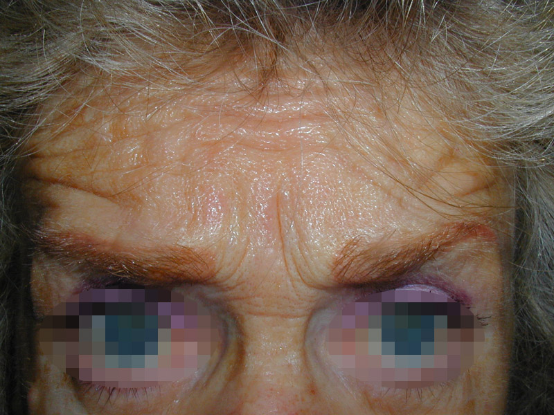 Photo après injection de botox dans le visage par le chirurgien