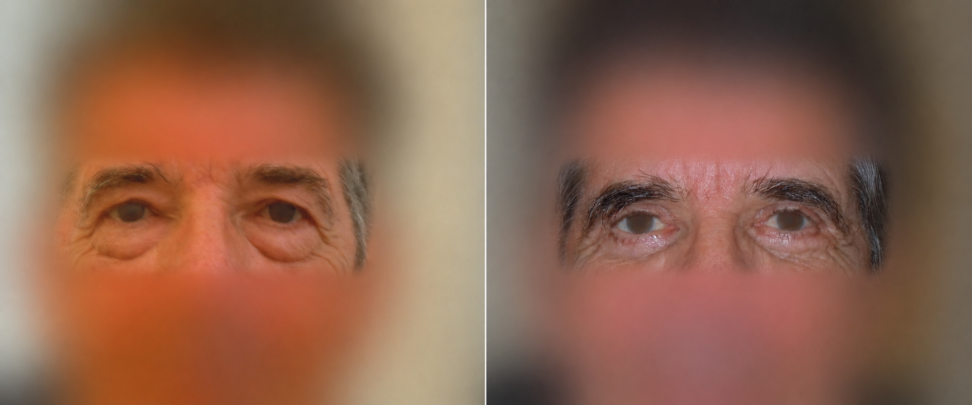 Résultat avant et après une chirurgie des paupières, visage anonymisé autour des yeux