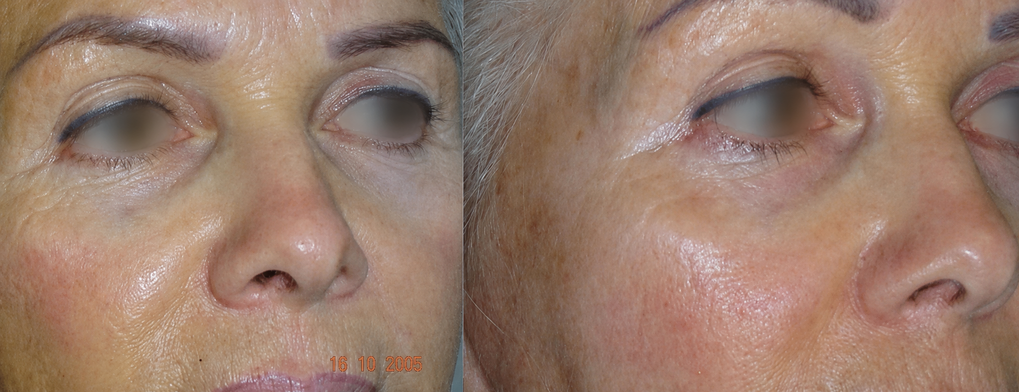 Cas clinique Plasma Pen avant et après, yeux floutés