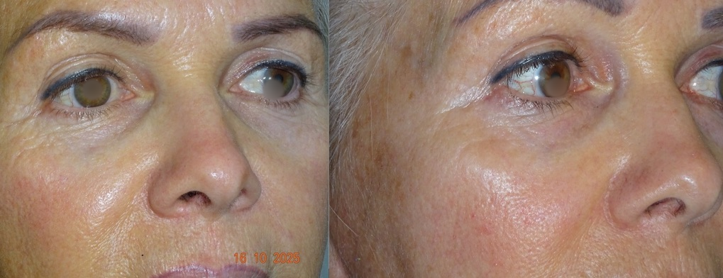 Cas clinique Plasma Pen avant et après, pupilles floutées